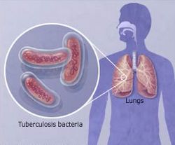 tuberkuloza